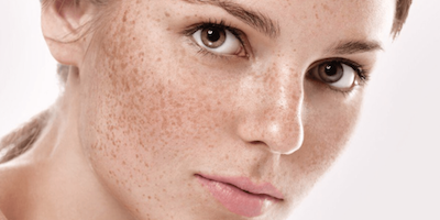 Bệnh rối loạn sắc tố da