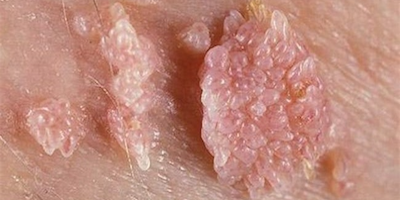 Bệnh lây truyền qua đường tình dục