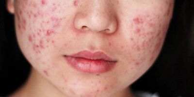 Bệnh do rối loạn phần phụ của da