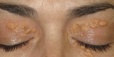 Bệnh da do rối loạn chuyển hoá