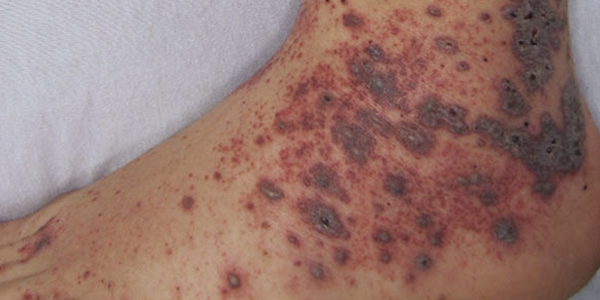 Viêm mạch, ban xuất huyết và các bệnh mạch máu khác