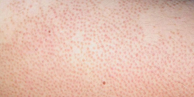 Bệnh da do vi khuẩn