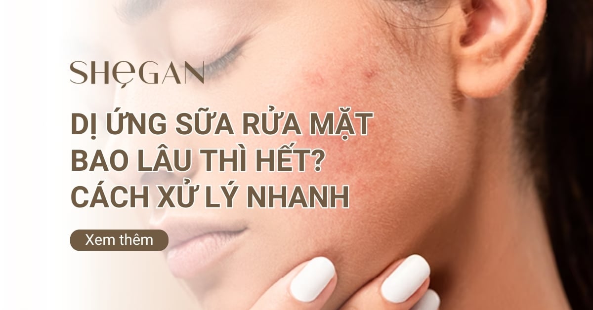 Dị ứng sữa rửa mặt bao lâu thì hết? Cách xử lý nhanh