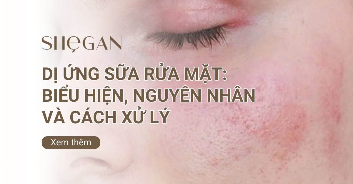 Dị ứng sữa rửa mặt: Biểu hiện, Nguyên nhân và Cách xử lý