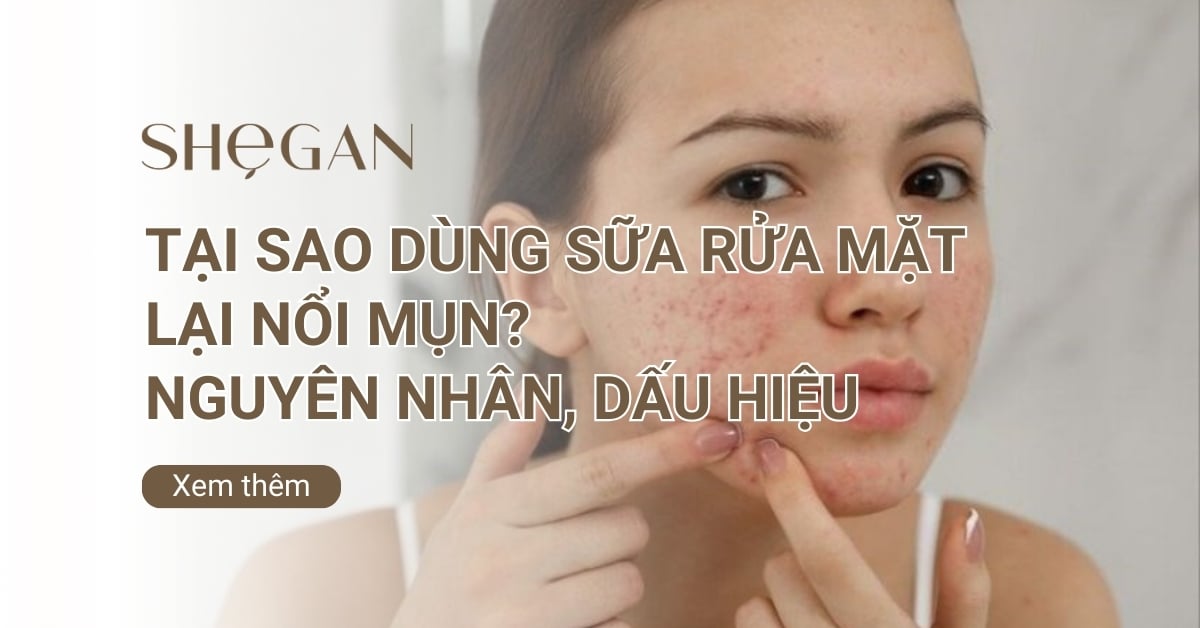 Tại sao dùng sữa rửa mặt lại nổi mụn​? Nguyên nhân, Dấu hiệu