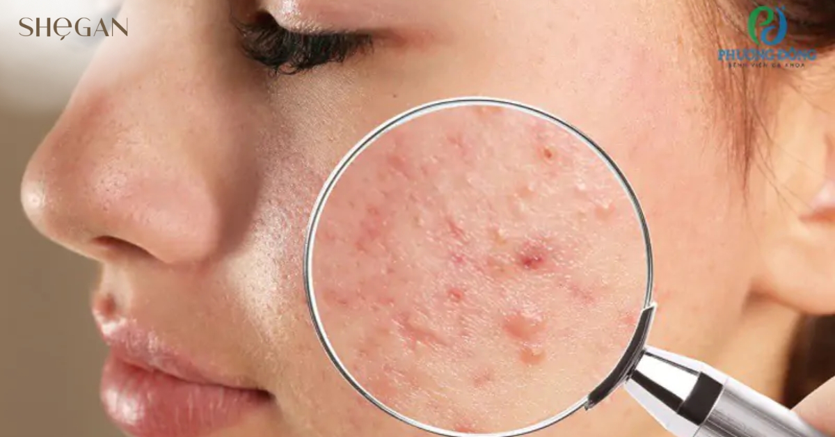 Trị mụn trứng cá