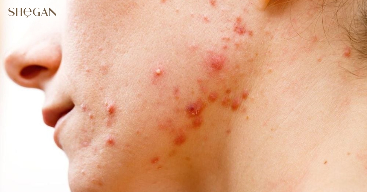 Dấu hiệu dùng tẩy trang bị rát mặt
