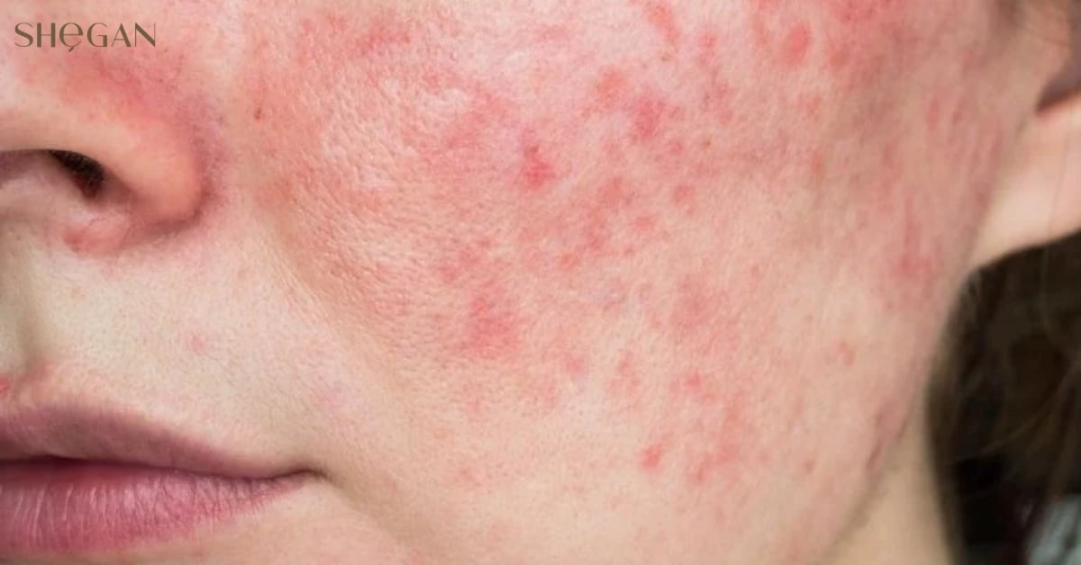 Các dấu hiệu bị dị ứng sữa rửa mặt