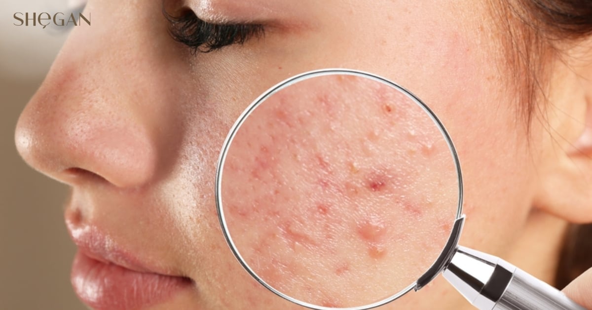 Mặt mụn có nên dùng nước tẩy trang