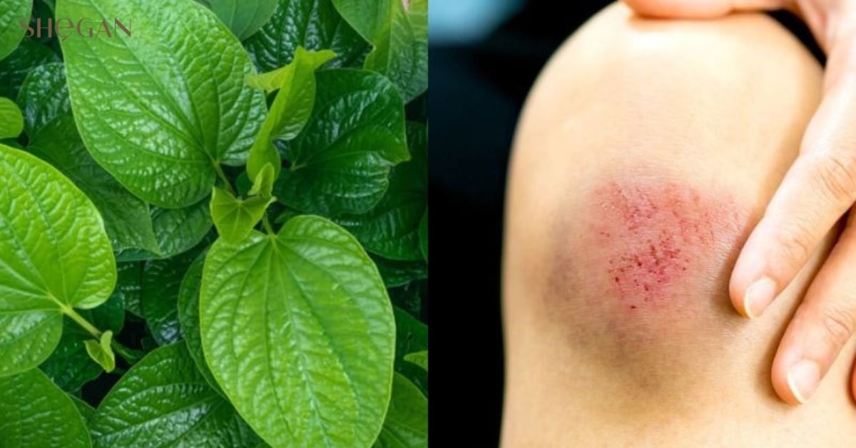 Sát khuẩn hiệu quả, hỗ trợ lành vết bỏng