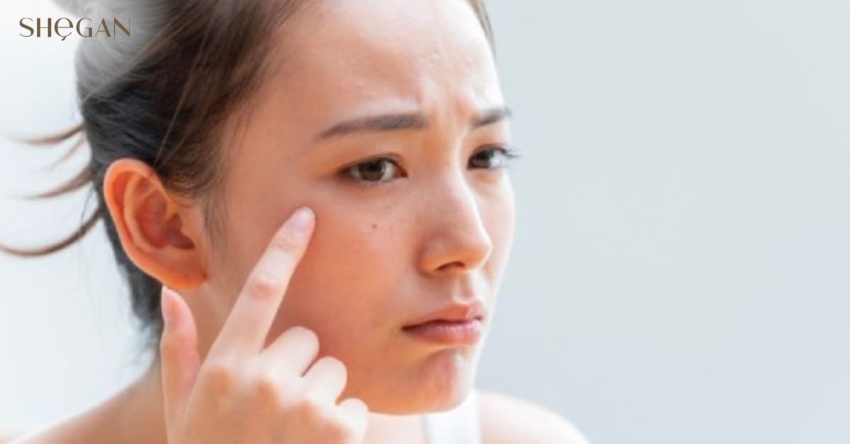 Nguyên nhân của việc dùng nước tẩy trang bị rát mặt