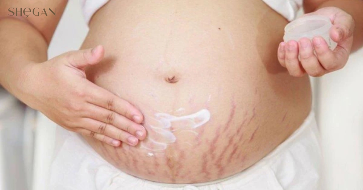 Cách chăm sóc da cho mẹ bầu bị rạn da