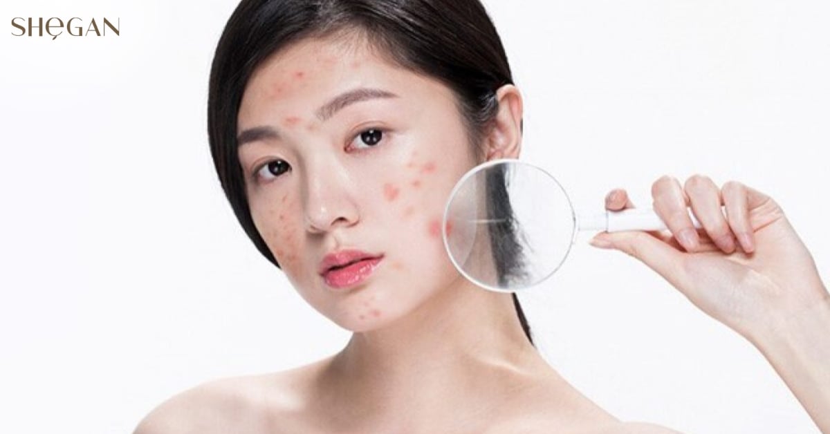 Da bị kích ứng và nổi mụn