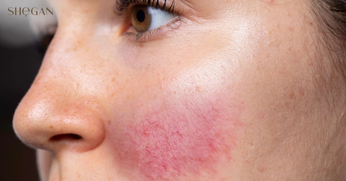 Dị ứng với sữa rửa mặt là gì?