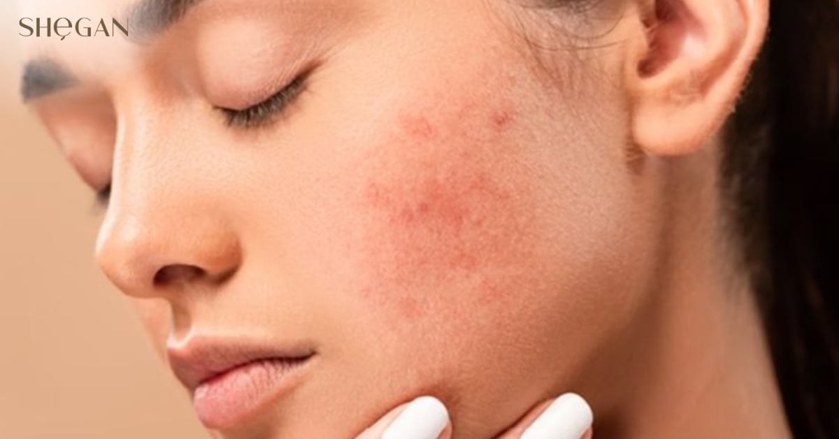 Triệu chứng của dị ứng với sữa rửa mặt
