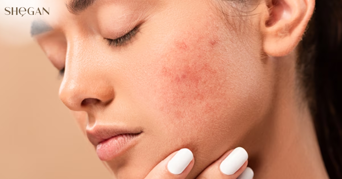 Da bị kích ứng mạnh, đỏ rát