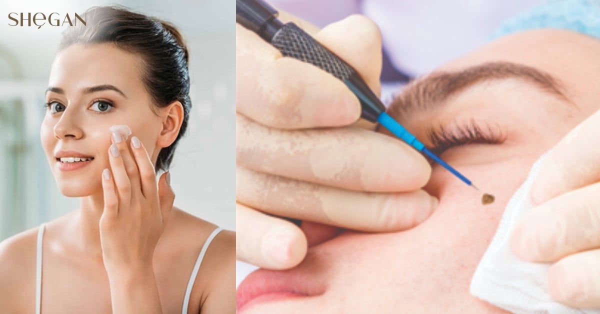 Tẩy nốt ruồi có được dùng sữa rửa mặt không