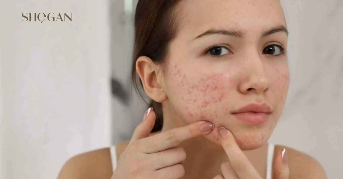 Nặn mụn xong có nên dùng sữa rửa mặt không