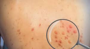 Biện pháp nào cho bệnh Đậu Mùa Khỉ?