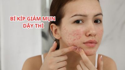 Bí Kíp Giảm Mụn Tuổi Mới Lớn