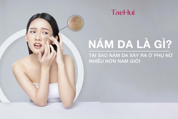 Nám da là gì? Tại sao nám da xảy ra ở phụ nữ nhiều hơn nam giới