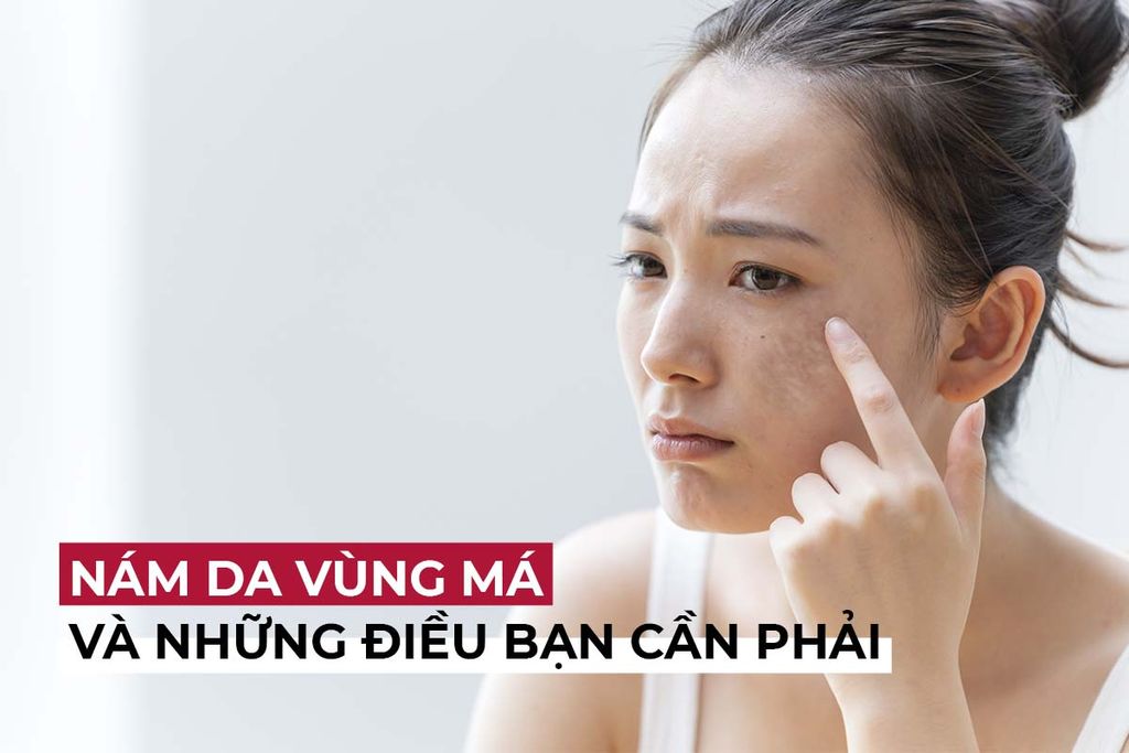 Nám da mặt vùng má và những điều bạn cần phải cần biết – TaeHui Việt Nam