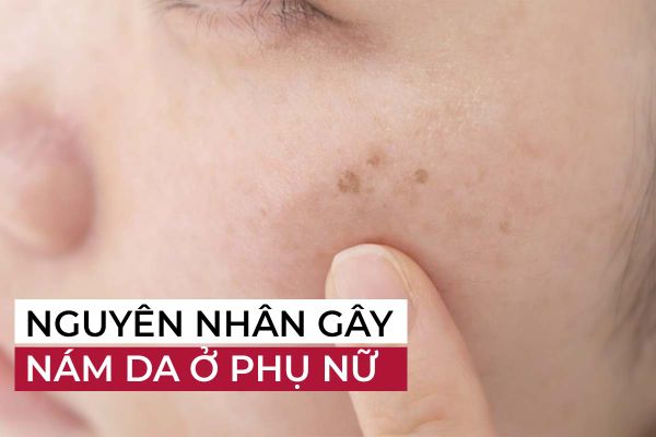 Nguyên nhân gây nám da ở phụ nữ mà nhiều chị em chưa nắm rõ?