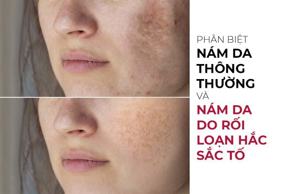 Phân biệt nám da thông thường và nám da do rối loạn hắc sắc tố