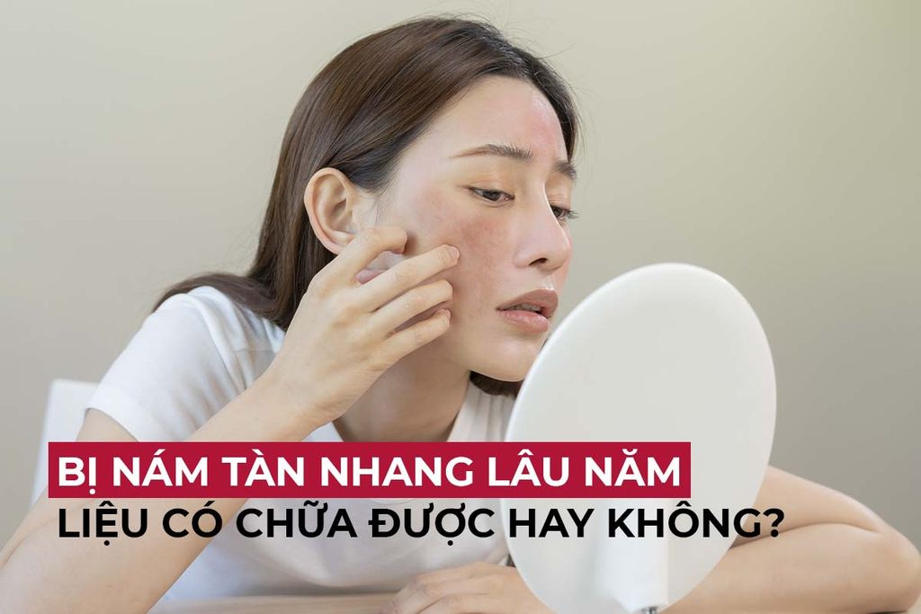 [GIẢI ĐÁP] Bị nám tàn nhang lâu năm liệu có chữa được hay không?