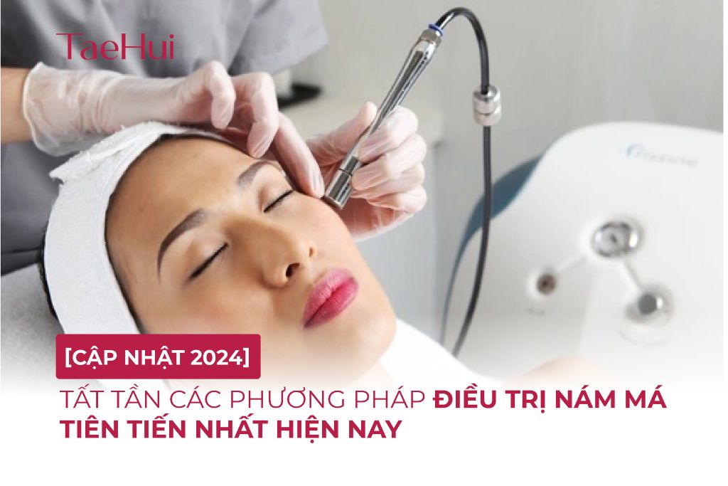 [CẬP NHẬT 2024] Tất tần các phương pháp điều trị nám má tiên tiến nhất hiện nay