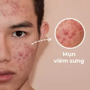 Mụn ở nam giới: Nguyên nhân và 5 cách ngăn ngừa mụn