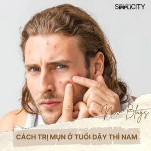 Mách bạn 11 cách trị mụn ở tuổi dậy thì nam tại nhà hiệu quả
