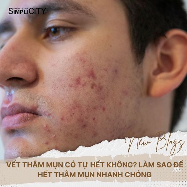 Vết thâm mụn có tự hết không? Làm sao để hết thâm mụn nhanh chóng