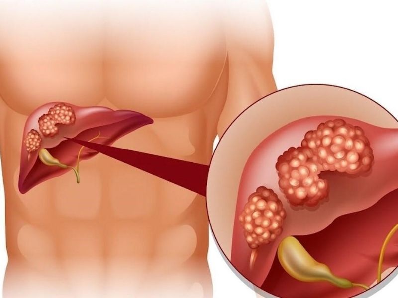 Các phương pháp thải độc gan hiệu quả nhất mà bạn không nên bỏ qua