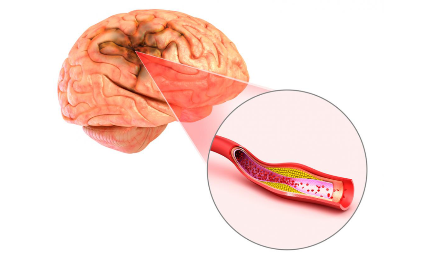Cách hỗ trợ quá trình trị thiếu máu não - Thiếu máu não lên làm gì?
