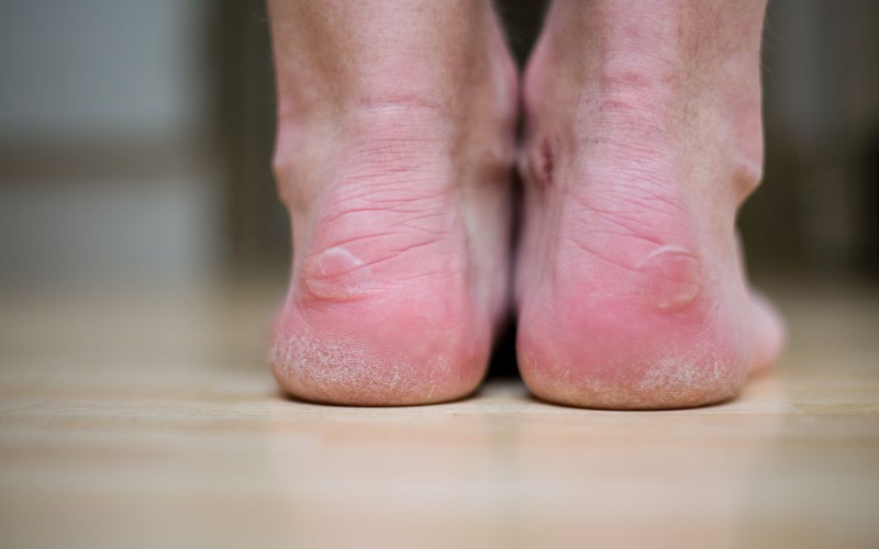 7 cách ngăn ngừa phồng rộp khi chạy bộ