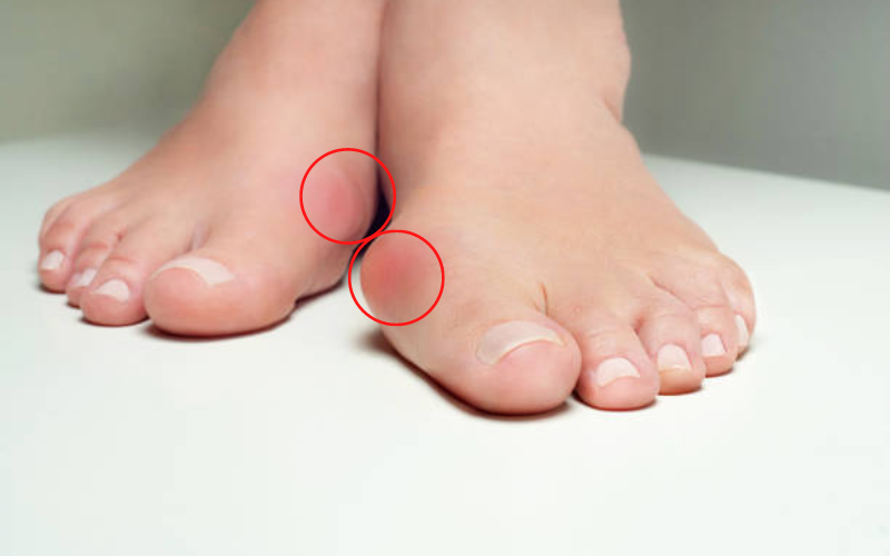 Viêm biến dạng đau khớp ngón chân cái
