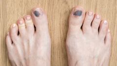 Tím móng khi chạy bộ: Nguyên nhân, cách phòng ngừa và xử lý hiệu quả cho runner