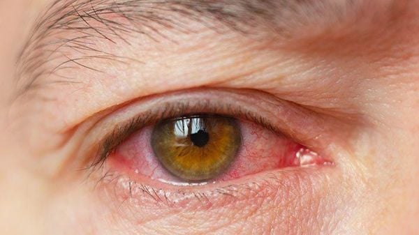 Thiếu nước không chỉ dẫn đến da khômà cnf khô mắt, đỏ mắt, mỏi mắt