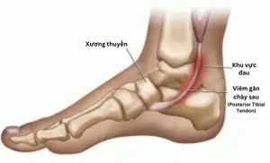 Viêm gân chày sau khi chạy bộ