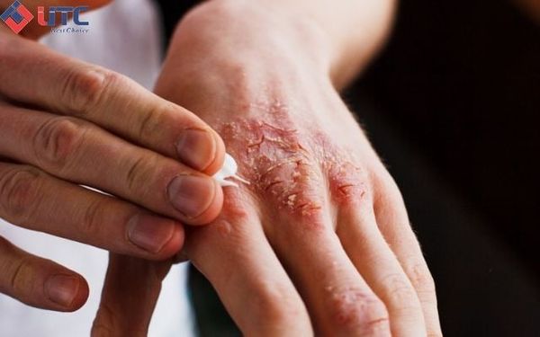 Muối rửa bát có thể gây tình trạng kích ứng da nếu không sử dụng đúng cách.