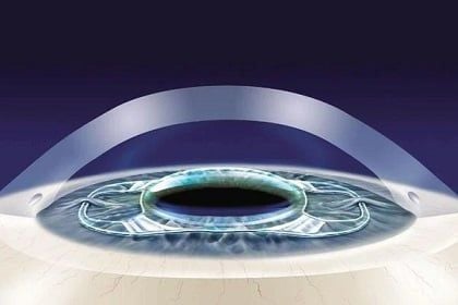 ReLEx SMILE và ICL: Đâu là lựa chọn phù hợp với bạn?