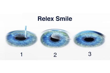 SMILE - MỔ CẬN CHỈ VỚI 23 GIÂY