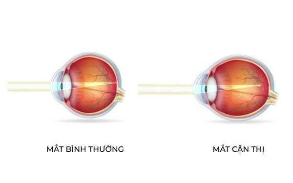 mắt thường với mắt cận