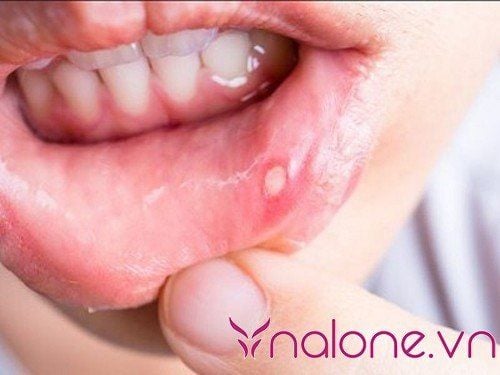 Nút lưỡi có bị nhiễm HIV không?