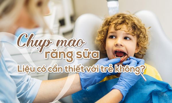 Chụp mão răng sữa: Liệu có cần thiết với trẻ không?