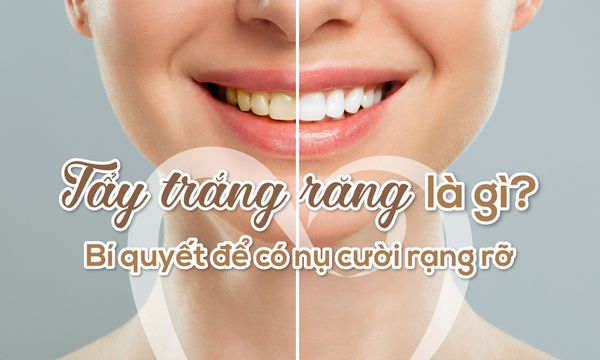 Tẩy trắng răng là gì? Bí quyết để có nụ cười rạng rỡ