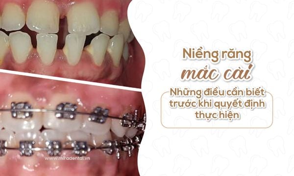 Những điều cần biết trước khi quyết định niềng răng mắc cài