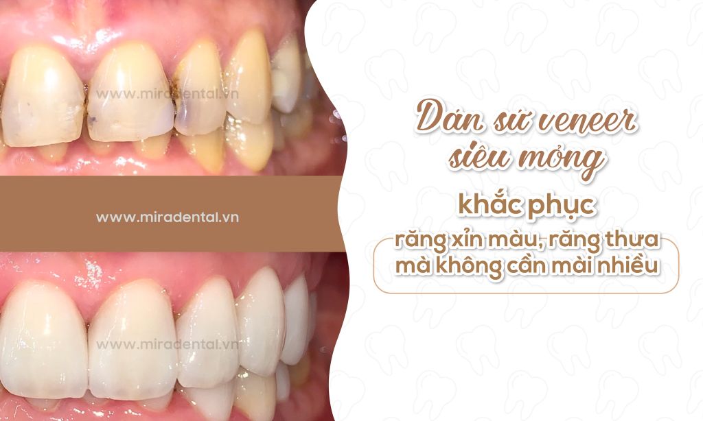 Dán sứ veneer siêu mỏng – Khắc phục răng xỉn màu, răng thưa mà không cần mài nhiề
