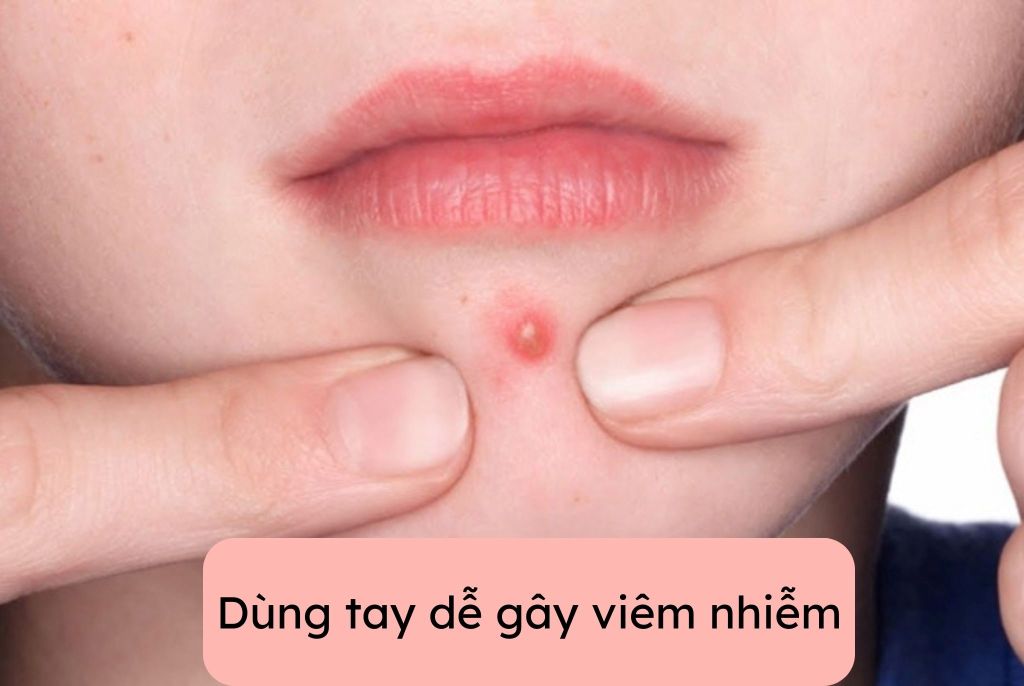 Dùng tay nặn mụn tiềm ẩn nguy cơ gì?